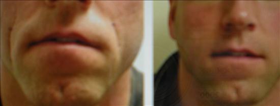 male before and after fillers